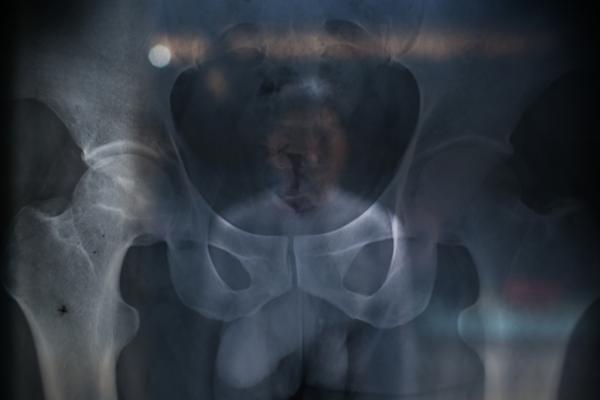 不知情的當(dāng)?shù)卮迕裰钡?005年仍食用污染田地生產(chǎn)的大米，不少村民被檢測出鎘超標(biāo)。10年前，黃懷權(quán)的髖關(guān)節(jié)股骨頭壞死，手術(shù)后，他喪失了勞動(dòng)能力。 權(quán)義 澎湃資料